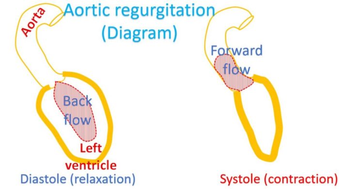 Hesi case study aortic regurgitation