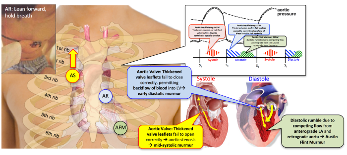 Hesi case study aortic regurgitation