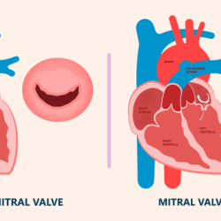 Hesi case study aortic regurgitation