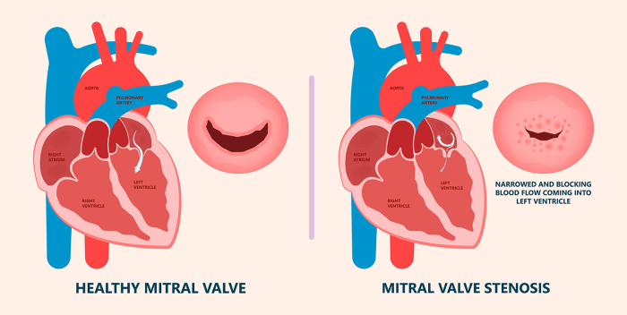 Hesi case study aortic regurgitation